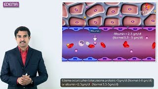 1Edema introduction  Hemodynamic pathology Fmge Neet PG and usmle [upl. by Meikah]