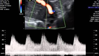 Ecografia morfologica flussimetria arteria uterina [upl. by Sivar]