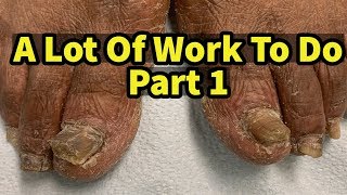 Severe Fungal Fungus Toenails A Lot Of Work To Do Part 1 [upl. by Bohaty]