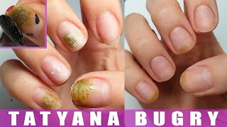 How I Cured My Nails  Shocking Experience  Restoring Nails from Bacteria [upl. by Ellinnet]