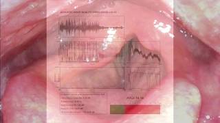 INJECTION LARYNGOPLASTY  RIGHT VOCAL FOLD PALSY [upl. by Gilberta]