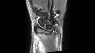 Triangular Fibrocartilage Complex TFCC tear  styloid and foveal attachments [upl. by Kahl65]