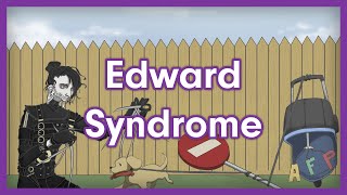 Edward Syndrome Trisomy 18  USMLE Step 1 Mnemonic [upl. by Absa]