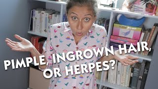 Pimple Ingrown Hair or Herpes [upl. by Pulling543]