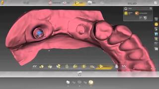 inLab SW 15 – Implantatgetragene Brücke [upl. by Nosnaj]