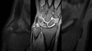 Triangular fibrocartilage TFCC tear wrist MRI [upl. by Patrich]