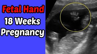 Fetal Hand  18 weeks pregnancy [upl. by Baldwin42]