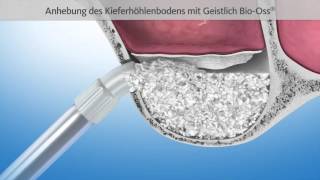 Knochenaufbau mit Sinuslift  Patienten Information [upl. by Priestley]