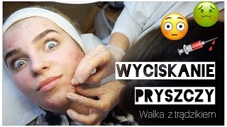 WYCISKANIE PRYSZCZY 😱💉 walka z trądzikiem 💪 [upl. by Ymerej]