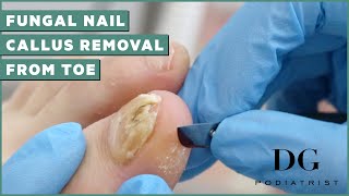 Fungal Nail Treatment And Callus Removal  The Foot Scraper DG Podiatrist [upl. by Gilletta]