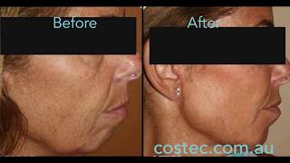 HIFU™ treatment  Before amp After pictures for Face Lift and Skin Tightening [upl. by Baras]