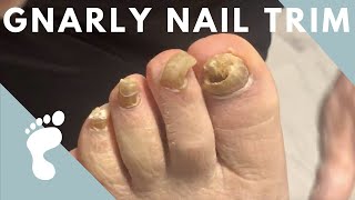 FUNGAL NAIL TRIM [upl. by Nitsoj648]