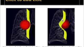 Mediastinal masses approach [upl. by Deirdra]