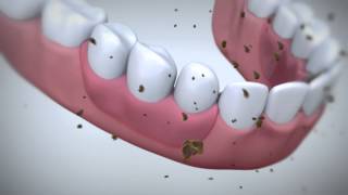 How does Fixodent denture adhesive work [upl. by Hammel]