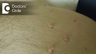 How to manage a small tissue tag in male genitals  Dr Nischal K [upl. by Nyral77]