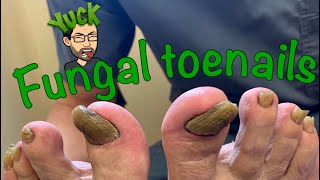 CUTTING LONG TOENAILS WITH FUNGUS [upl. by Rici]