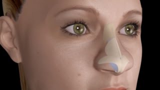 Bulbous Large Nasal Tip Nose Job Rhinoplasty [upl. by Nerha]