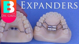 BRACES EXPLAINED Palatal Expanders [upl. by Kellyann]