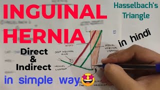 Inguinal Hernia Anatomy 12  Direct and Indirect Inguinal Hernia  Abdomen  Anatomy [upl. by Howlond]