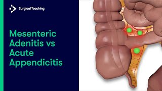 Mesenteric Adenitis vs Appendicitis  How to tell the difference [upl. by Bartlet911]