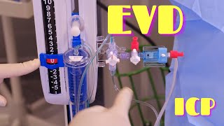 External Ventricular Drainage EVD and ICP Monitoring [upl. by Nikaniki]