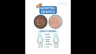 Genital Herpes [upl. by Rikki]