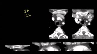 Mediastinal anatomy and nodal stations on CT [upl. by Boothman]