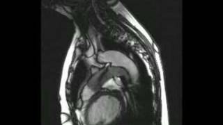 Patent ductus arteriosus on echocardiography [upl. by Kadner]