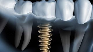Welches Zahnimplantat System ist das beste [upl. by Dadelos368]