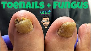 HOW TO CUT THICK TOENAILS WITH FUNGUS [upl. by Maril28]