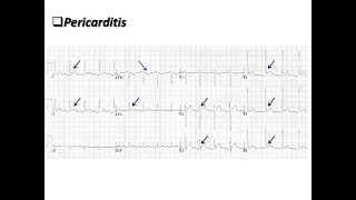 Constrictive pericarditis diagnosis echocardiography and treatment [upl. by Moore]