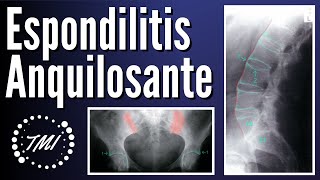 Espondilitis Anquilosante [upl. by Joe]