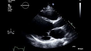 Ischemic Cardiomyopathy 2D Echocardiogram [upl. by Enelie]