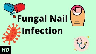 Fungal Nail Infection Causes Signs and Symptoms Diagnosis and Treatment [upl. by Melesa387]