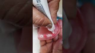 Applying Denture Creme Adhesive [upl. by Suirauqram575]