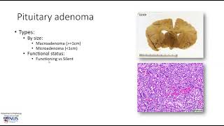 Brain Pituitary adenoma [upl. by Enitnelav]