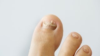 How to prevent and treat nail fungus [upl. by Voccola]