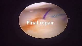 Ulnar TFCC repairSurgical steps [upl. by Atews]