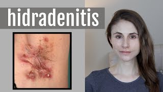 HIDRADENITIS SUPPURATIVA QampA WITH DERMATOLOGIST DR DRAY [upl. by Ocnarfnaig]