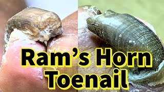 Rams Horn Toenail Severe Fungal Toenail [upl. by Bealle]