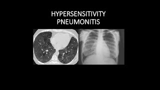 HYPERSENSITIVITY PNEUMONITIS  CLINICORADIOLOGICAL VIDEO SERIES CHEST [upl. by Mattias]