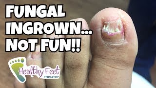 Removing a Fungal Ingrown Nail [upl. by Ater]