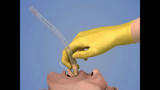 Laryngeal Mask Airway Insertion [upl. by Llerral]