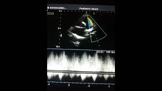 Ventricular Septal Defect Animation [upl. by Schapira5]