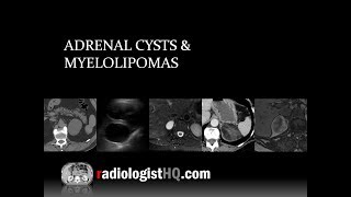 Adrenal Cysts and Myelolipomas [upl. by Audras]