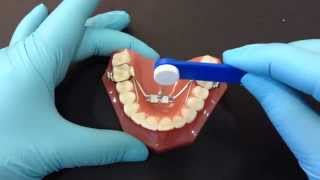 Palatal Expander Activation [upl. by Aniraz]