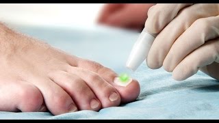 Toenail Fungus Onychomycosis treatment using the FOX Laser [upl. by Elagibba]