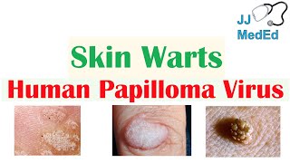 Overview of Skin Warts Verrucae  What Causes Them Who Gets Them  Subtypes and Treatment [upl. by Eldrid]