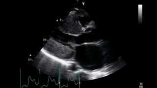 Restrictive Cardiomyopathy  Transthoracic Echocardiogram TTE [upl. by Margette]