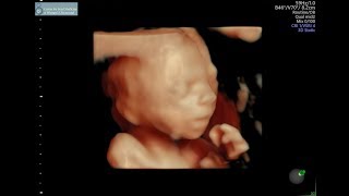 20 week ultrasound [upl. by Anileve416]